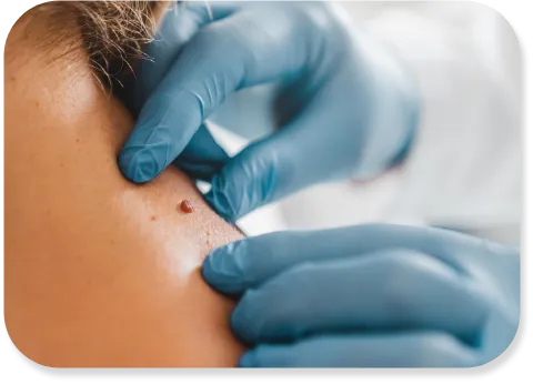 DPN & Skin Tag Removal