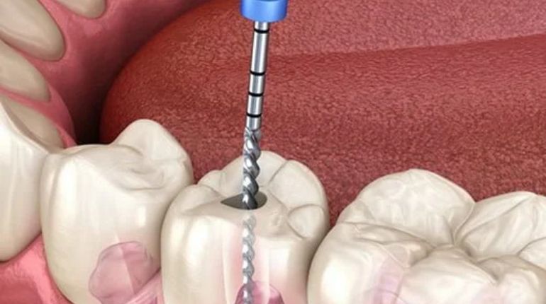 root canal treatment in ahmedabad