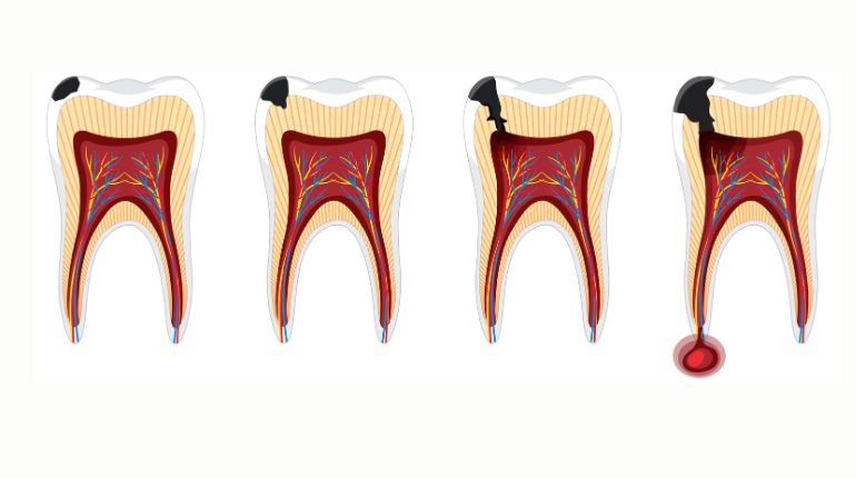 Root Canal Treatment in Ahmedabad