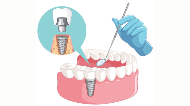 Dental Implants Cost Ahmedabad