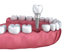 dental implants